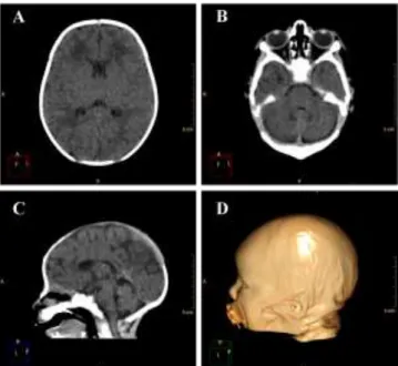 Figure 3. Example of a normally developed 10 days old newborn. A and B. Axial images of the brain showing the lateral ventricles and the cerebellum with its regular dimensions