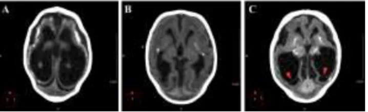 Figure 4. Axial non-contrast brain CT with three different patterns of parenchymal atrophy and compensatory ventricular dilation