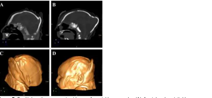Figure 7. Sagittal sections present evidence of cranial bone overlap (A), frontal and occipital bones