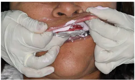 Figura 8 – Tracionamento do lábio e bochecha do paciente durante o ato de moldagem