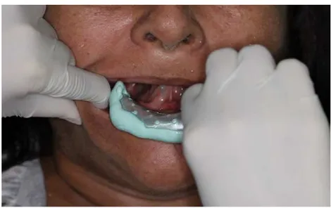 Figura 11 – Inserção da moldeira de estoque na cavidade bucal da paciente