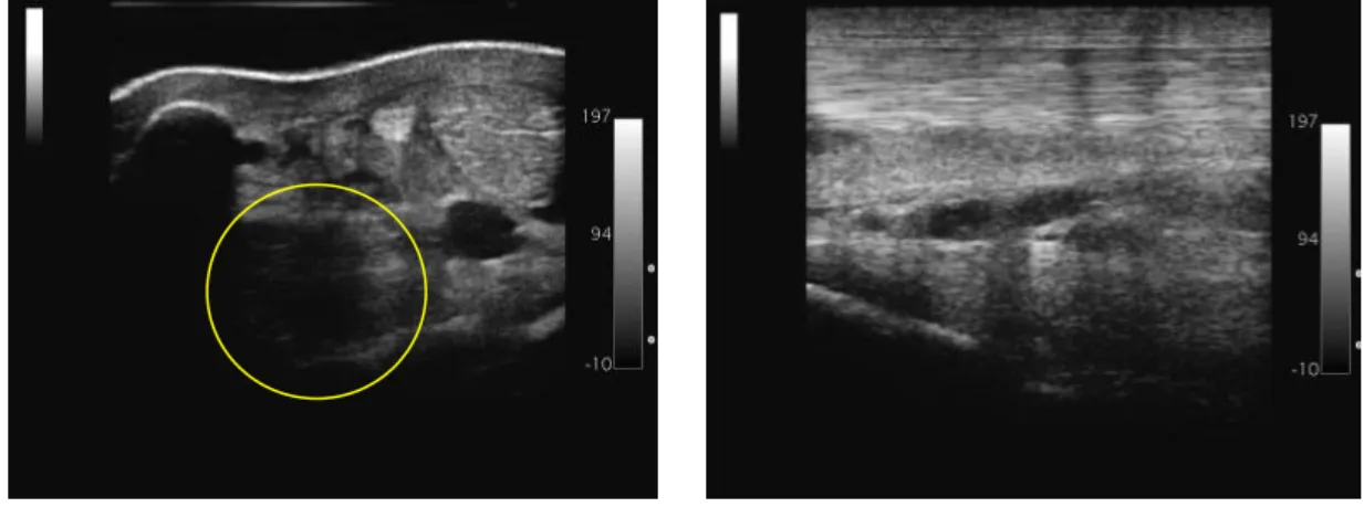 Figura 6. Imagens ecográficas em corte transversal (esquerda) e longitudinal (direita) da região proximal do LSB do MP esquerdo