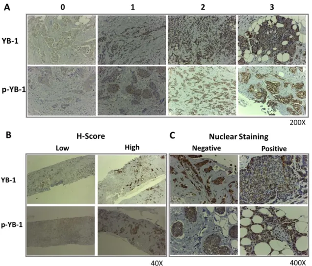 Figure  2.  Representative  images  of  YB-1  and  p-YB-1  immunostaining  in  primary  BC  tissues