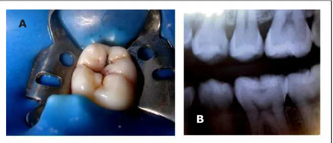 Figura 02 – Critérios de inclusão do estudo: superfície oclusal sem cavitação clínica (A)  e comprometimento dentinário verificado através do exame radiográfico (B)