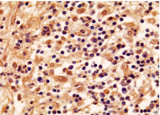Figura 11  Expressão  imuno-histoquímica  da  OPG  na  cápsula  do  cisto  radicular.  Observe  imunomarcação  em  células  inflamatórias  do  tipo mononuclear e polimorfonuclear