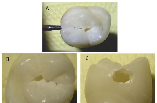 Figura 1 -  Desgaste do dente realizado com broca 1014 para cavidades do tipo classe I (A, B) e classe  II (C)