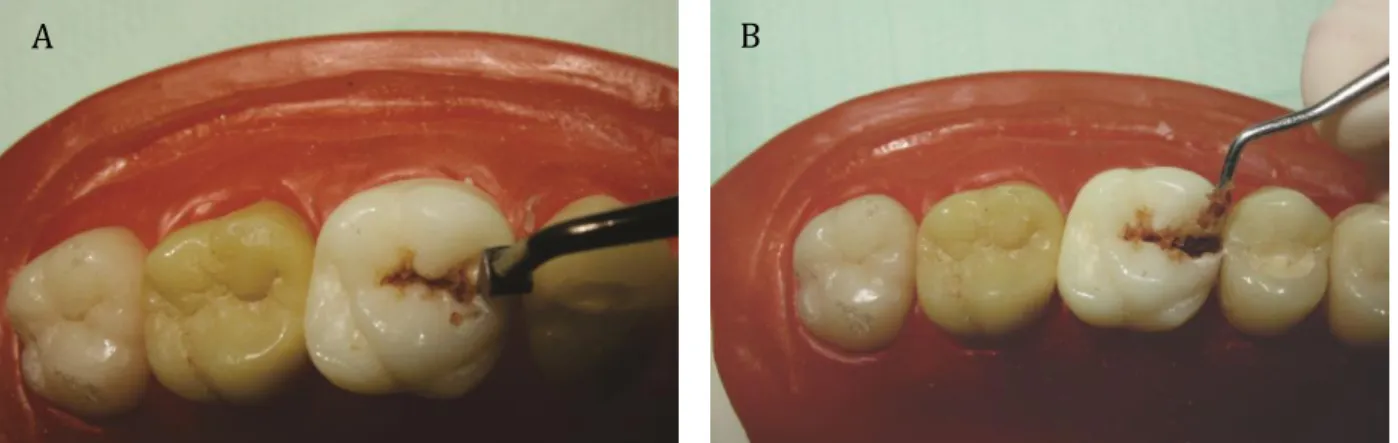Figura 7 -  Instrumento “opener” sendo apoiado sobre o esmalte para promover acesso à lesão (A) e  remoção do tecido cariado amolecido com colher de dentina (B)
