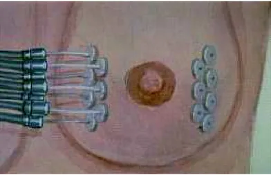 Figura 2.4: Exemplo de implantação de 
atéteres em um típi
o 
aso de 
ân
er de mama