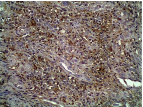 Figura 6.  Fotomicrografia demonstrando intensa marcação das  células tumorais, estromais e inflamatórias com anticorpo  anti-RANKL, no carcinoma epidermóide de palato duro