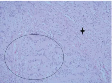 Figure 1. Presence of a sessile, nodular lesion of firm consistency, located in the                  left jugal mucosa
