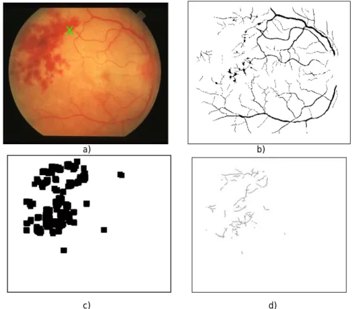 Figura 4.14 – Imagem 20 - STARE. a) Localização do DO; b) Segmentação da rede vascular; c) Candidatos  do método de intensidade; d) Candidatos finais a DO