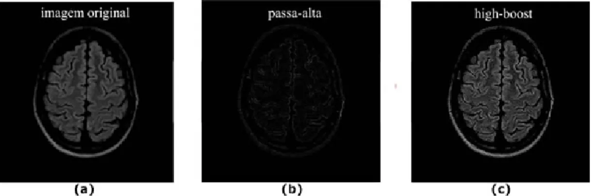 Figura 5: Imagem original (a) filtrada com passa-alta (b) e high-boost (c).
