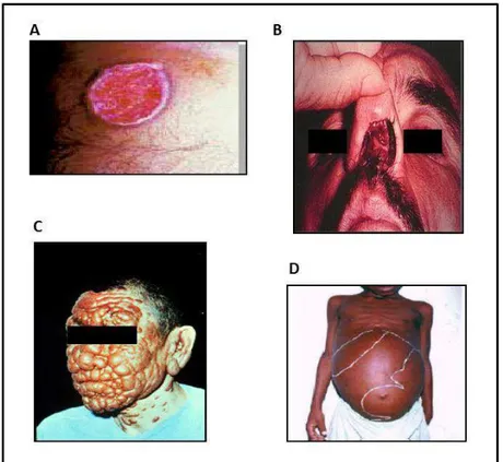 Figura 3: Manifestações clínicas das Leishmanioses.  A: leishmaniose cutânea, B:  leishmaniose cutâneo-mucosa, C: leishmaniose cutâneo-difusa, D: leishmaniose visceral