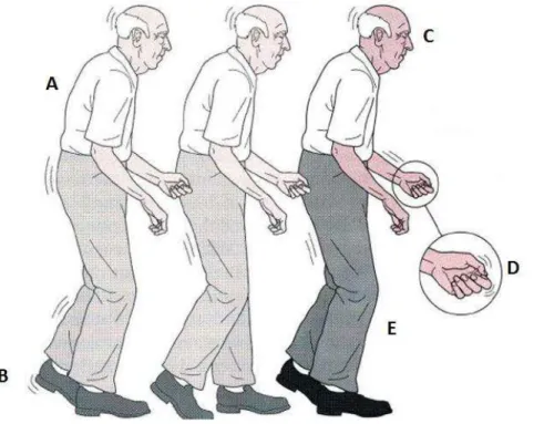 Figura  4.  Características  motoras  da  doença  de  Parkinson.  A)  Aumento  da  curvatura torácica e redução da mobilidade da coluna vertebral