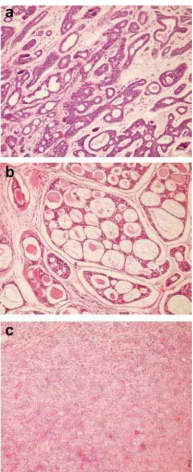 Figura 7. Padrões histológicos apresentados pelos carcinomas adenóides císticos   de glândulas salivares menores
