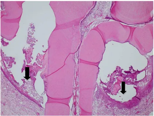 Figura 6  – Fotomicrografia da figura 5, em maior aumento. As setas indicam o epitélio gengival  que  migrou  em  decorrência  da  perda  óssea,  e  um  infiltrado  inflamatório  no  tecido  conjuntivo  subjacente (HE, aumento de 100x)