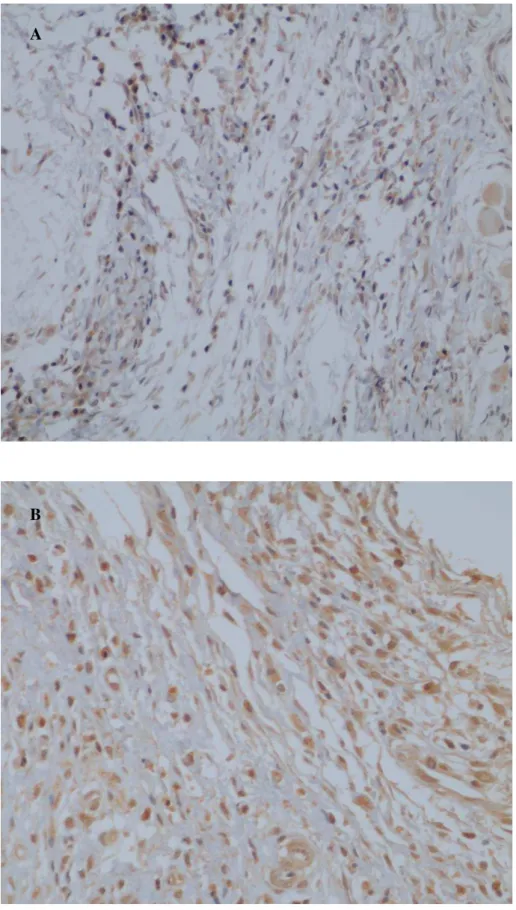 Figura  8  –  Observa-se  nas  figuras  A  e  B,  infiltrado  linfocitário  exibindo  imunomarcação  intracitoplasmática ao fator de transcrição GATA-3