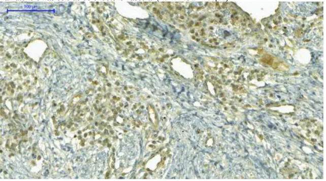 Figura  5  -  Imunoexpressão  do  EMMPRIN  evidenciada  principalmente  nas  células  do  infiltrado  inflamatório e nas células do endotélio vascular (ADVANCE - 100µm)