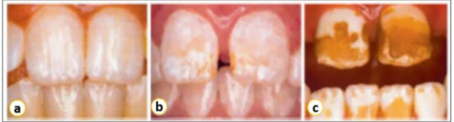 Figura 1. Casos de fluorose dentária. Em a fluorose de grau  leve; b fluorose moderada; c fluorose severa