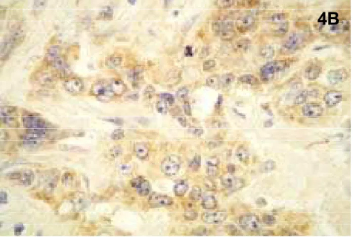 Figura 4. Imunomarcação da integrina D3E1 em carcinoma  epidermóide oral. (A): Marcação difusa nas células  parenquimatosas (SABC-100x)