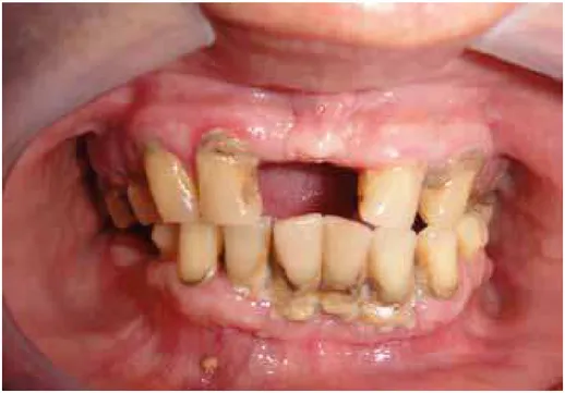 Figura 01: Paciente dialítico com doença periodontal. Natal/RN. 2012. 