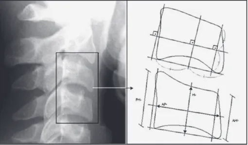 Figure 1 -  Body of cervical  vertebrae C3 and C4  measured by means of lateral  cephalometric X-rays: (AH)  anterior height of the vertebral  body, (AP) lateral  anterior-posterior of the vertebral body  and (H) height of the vertebral  body, (PH) posteri