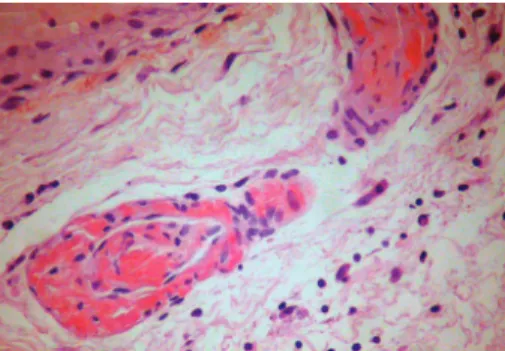Figure 1: Chest computed tomography: bilateral interstitial thick- thick-ening and bronchiectasis in the right hemithorax.