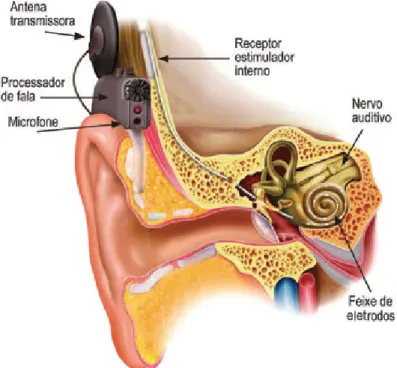 Figura 4 – Ilustração da orelha com Implante Coclear  