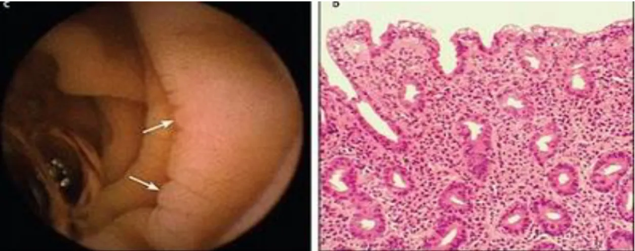 Figura 4: Vilosidades do intestino delgado de portador da doença celíaca  (MORAES, 2017) 