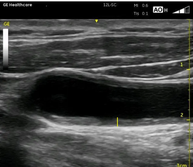 Figura    2.    Imagem  de  ultrassonografia  da  mensuração  da  camada  média-íntima  da  artéria carótida comum