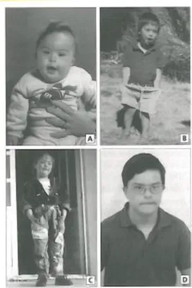 Figura 1- Imagens de uma pessoa com T21; A- aos 7 meses de idade; B- aos 2 anos; C- aos 3 anos; D - aos 12 anos  Fonte: Manual de Genética Médica, Fernando J