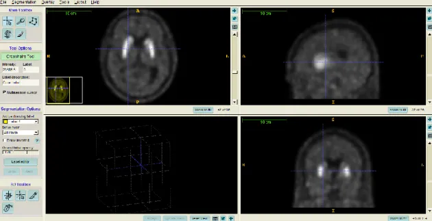 Figura 3.12: Imagem soma (0 aos 90 minutos) de um estudo PET dinâmico utilizando  11 C-RAC