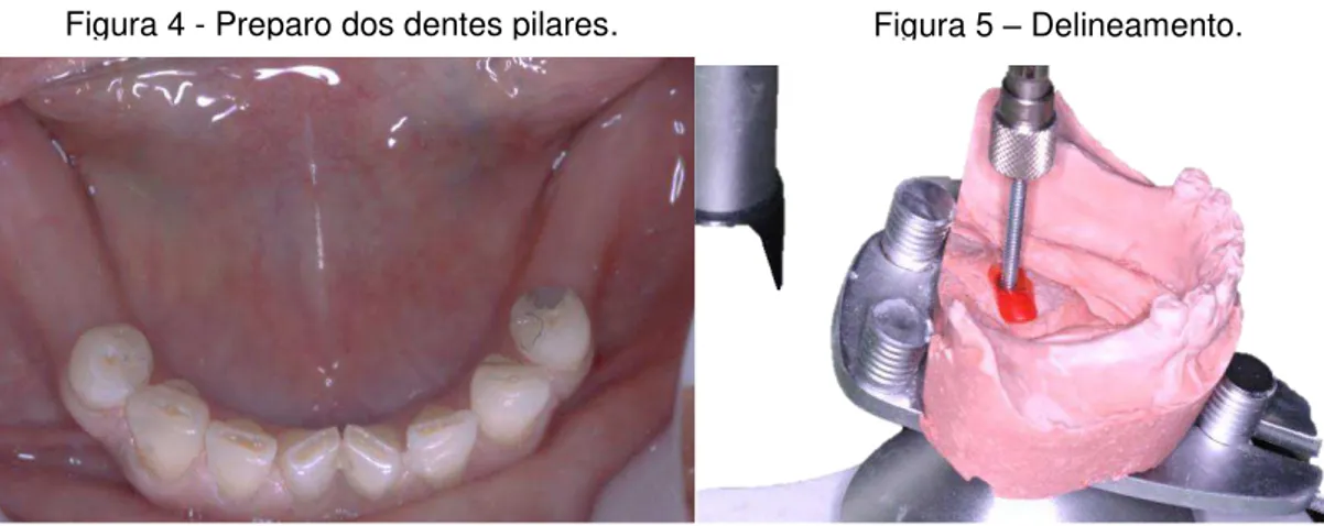 Figura 6 - Molde maxilar e modelo obtido. 