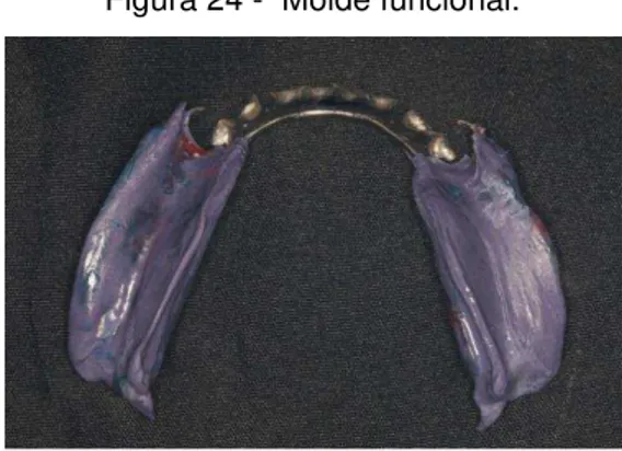 Figura 23 - Dentes em oclusão.                                         Figura 24 -  Molde funcional