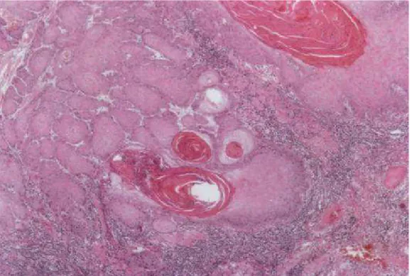 Foto 1 - Front invasivo de carcinoma epidermóide de baixo grau, de acordo 