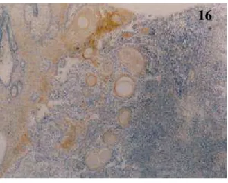 Foto 16-18 - (16) Figura evidenciando epitélio adjacente ao tumor com áreas de 