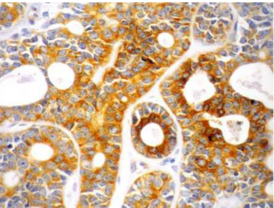 Figura 12. Fotomicrografia evidenciando a imunoexpressão da GLUT-1 no CAC padrão  tubular