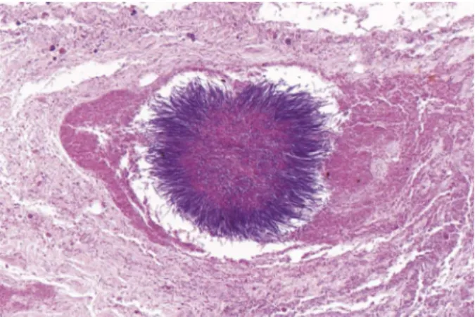 FIGURE 4. Sulfur granules present a central eosinophilic mass with peripheral basophilic rays (hematoxylin and eosin stain;  magnifica-tion, 400).