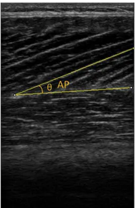 Figura  3.  Imagem  representativa  do  ângulo  de  penação  do  vasto  lateral  (VL)  mensurada  por  ultrassonografia  e  quantificada  no  software  ImageJ