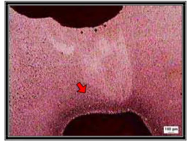 Figu r a  1 1 .  Fotomicrografia usada para medição da dentina  remanescente, seta destacando teto da câmara pulpar - Natal/RN, 2005