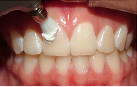 Figura  10.  Polimento  dentário  com  pasta  profilática  e escova  de  Robinson,  na  fase  do  exame inicial