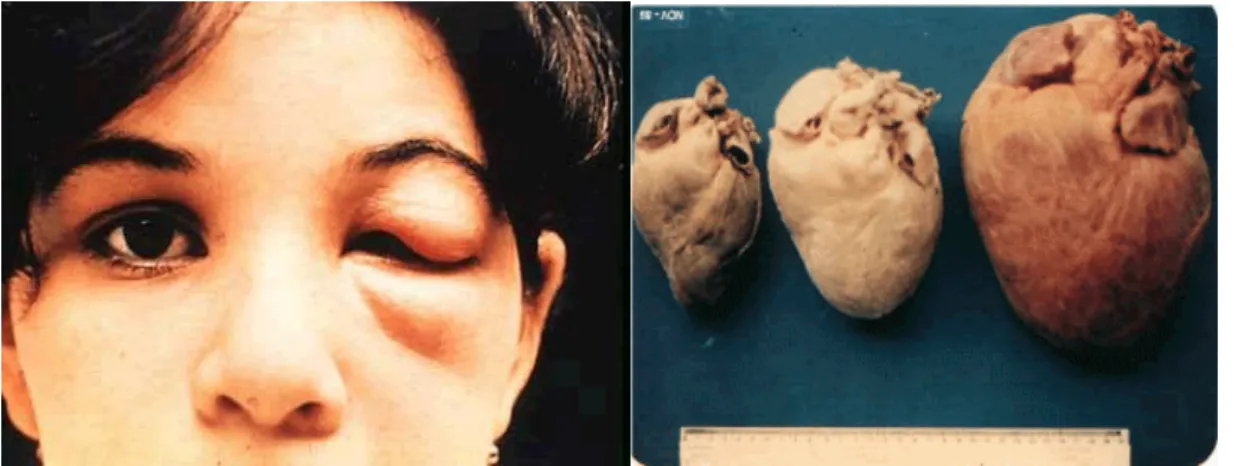 Figura  2  -  Pessoa  picada  pelo  vetor  (esquerda),  comparação  de  um  coração  sadio  com  um  no  estágio crônico da doença de Chagas (direita)