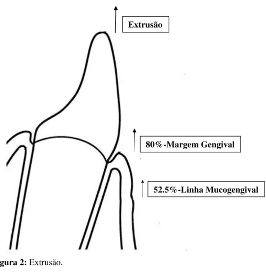 Figura 2: Extrusão. 