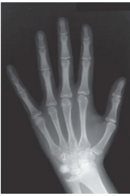 Figura 7 - Radiografia de mão e punho. (adaptado de Proffit, 2008)