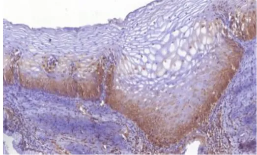 Figura  6.2  Grupo  NIC  I.  Imunomarcação  das  porções  das  amostras  lesionadas  com  grau  I  de  neoplasia (30% de imunomarcação) a) Epitélio estratificado (endocérvice) e tecido conjuntivo b) JEC  e tecido conjuntivo c) Epitélio colunar e tecido con