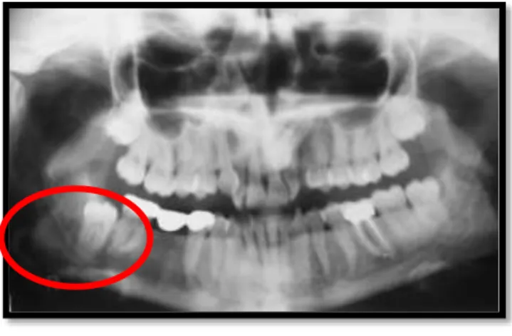 Figura nº 1 – Ortopantomografia pré-operatória com visualização do canal mandibular direito