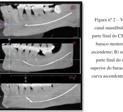 Figura nº 2 – Variações normais do trajecto do  canal mandibular: A) projecção directa, onde a  parte final do CM corre quase ao mesmo nível do 