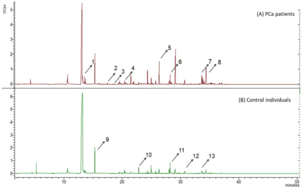 Figure  6  shows  the  representative  chromatograms  of the  carbonyl  compounds  profile  of  urine obtained from PCa patients and control individuals, after the derivatization process