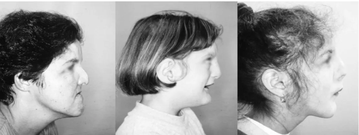 Figura nº 2: Vista lateral da face de pacientes com OFD I. É observado dolicocefalia e  retrognatismo maxilar