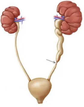 Figura nº 9: Hidronefrose do rim; seta na obstrução. 